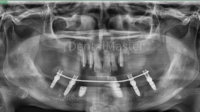 Radiografia panorâmica após restauração imediata