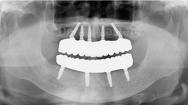 dental master permanente tandheelkundige restauratie gebogen oppervlak