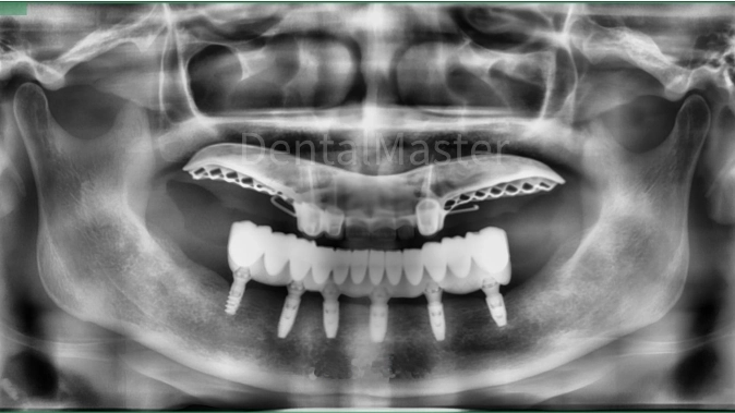 Posizionamento finale della protesi, radiografia panoramica (1)