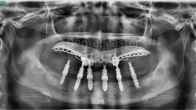 Radiografia dopo 4 mesi dall'intervento (cappetta per impronta in posizione)