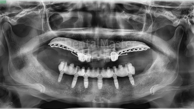 Trial fitting of the mandibular prosthesis (in place)