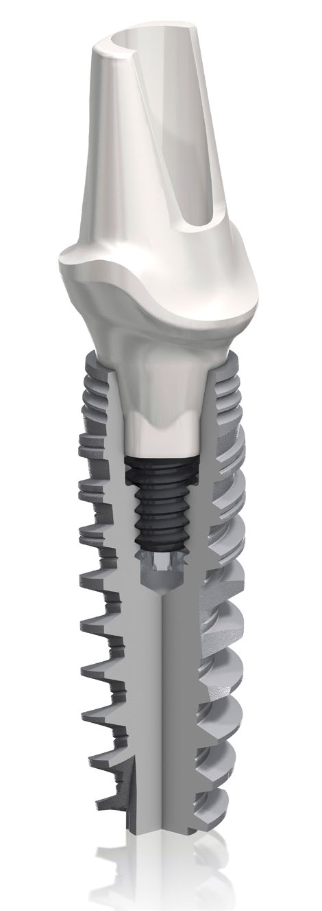 Healing Abutment and dental implants