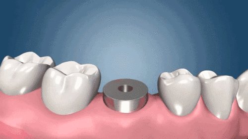 dental implant healing abutment