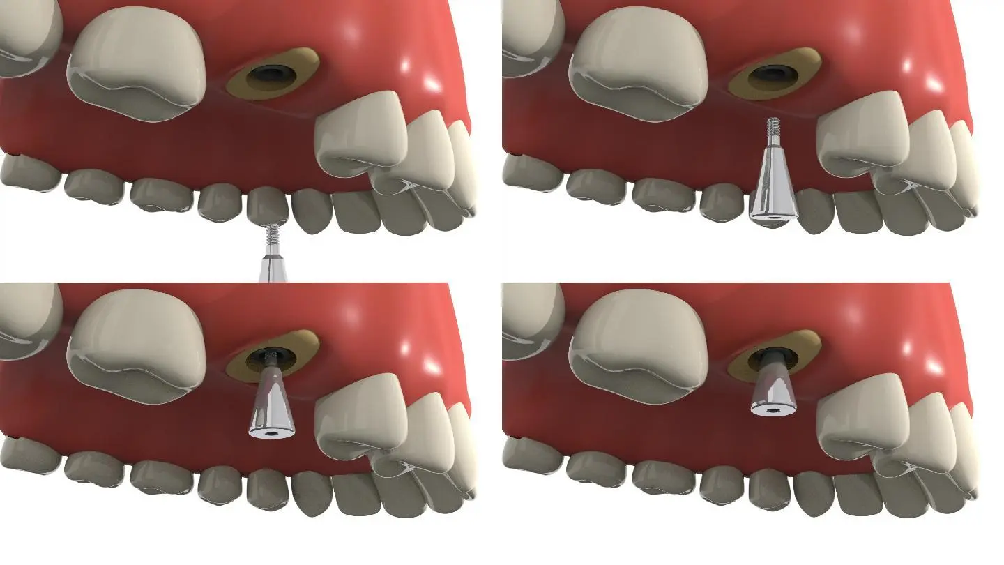 Installation of healing abutments