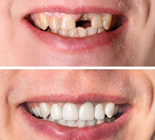 Dental implants before and after