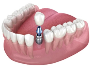 Single-Tooth Implants