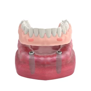 Locator Abutment Application 01