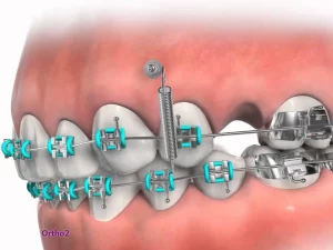 temporary anchorage device in orthodontics