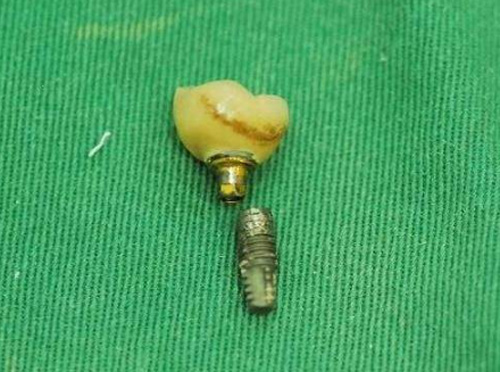 why do my dental implants keep breaking