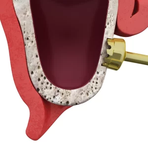 maxillary sinus lift