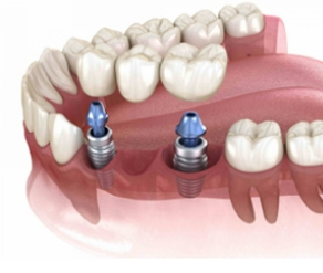 Multiple-Tooth Implants