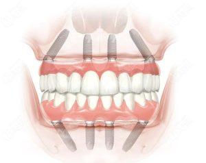 What is multi-unit abutment​