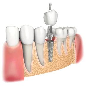 implantes dentales