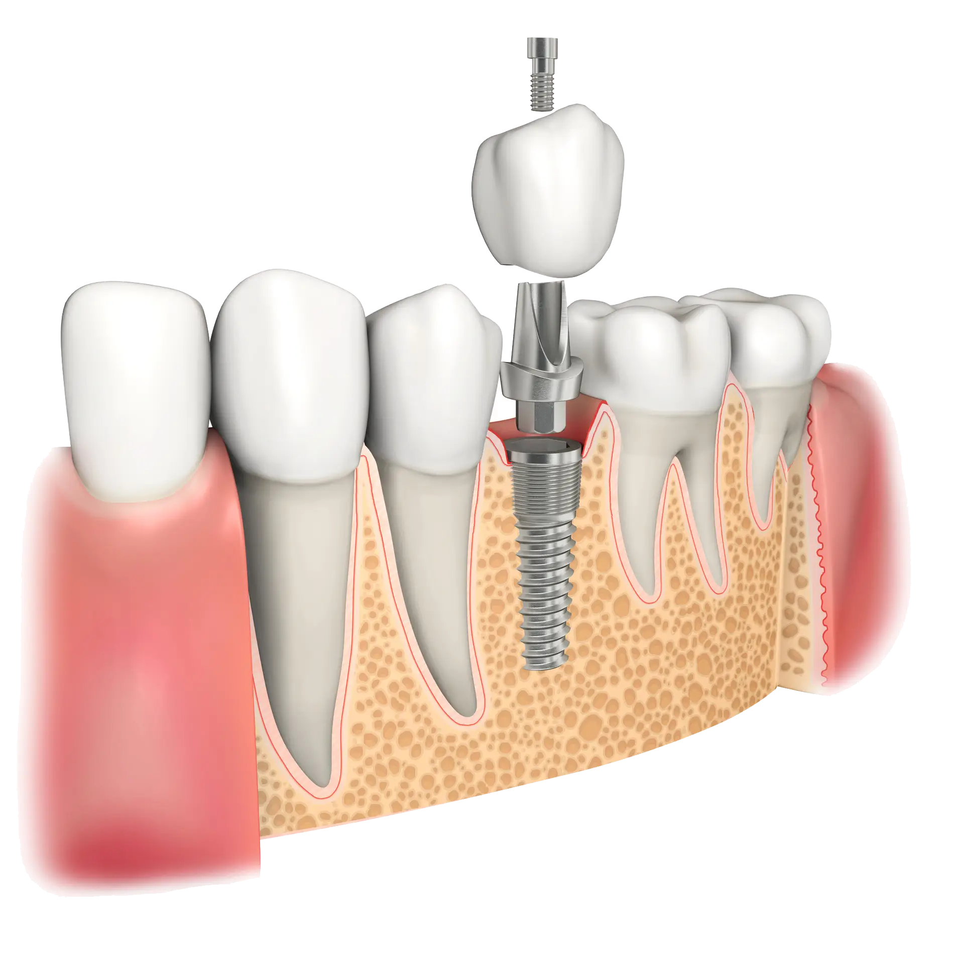 dental implants