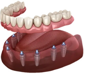 Full-mouth implants