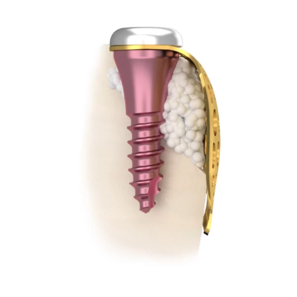 Membrane-Fixation-Screw-1