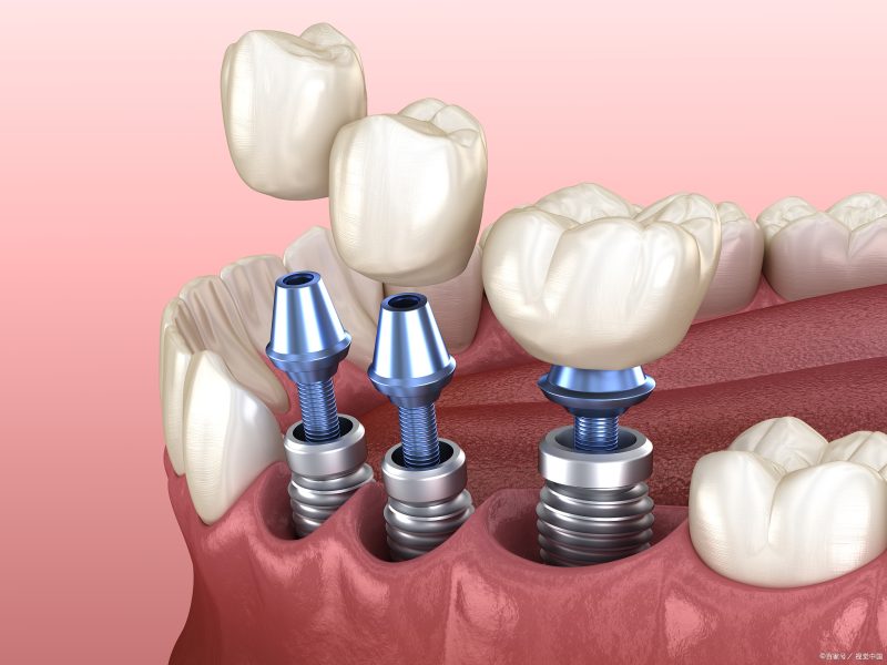 How long does it take to get dental implants