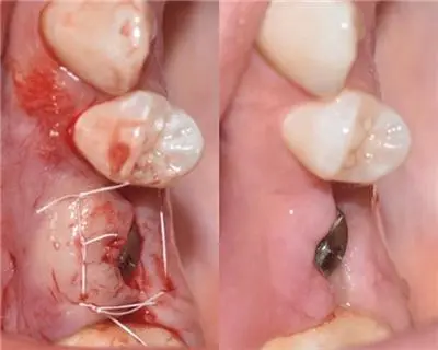 Dental Implant Surgery