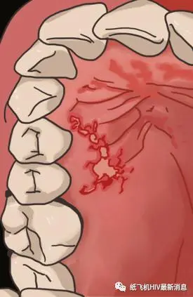 Survival Time of HIV on Dental Instruments