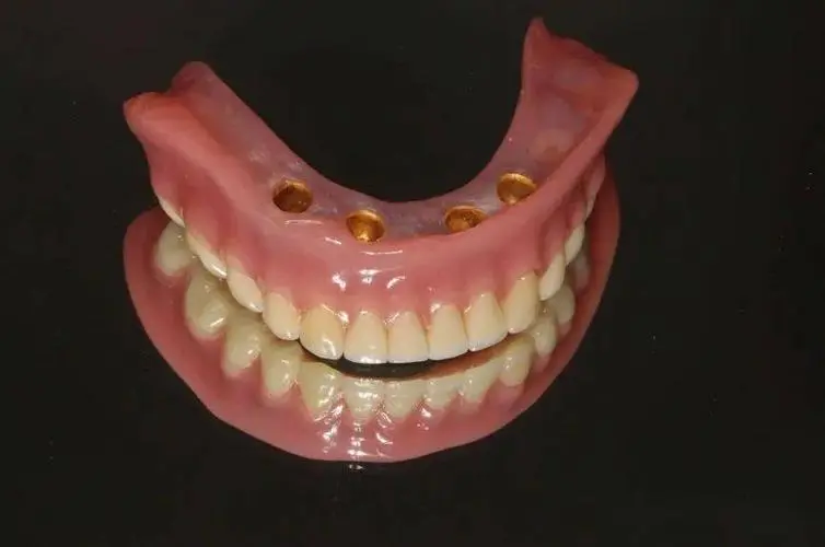 Overdentures