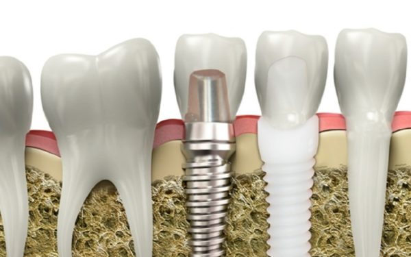 Titanium and Zirconia implants