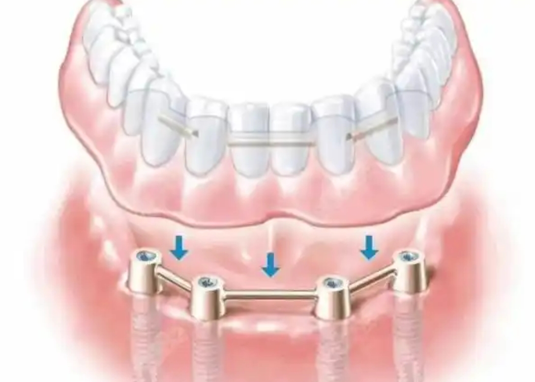 All-On-4 implants