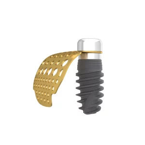 Titanium Mesh and implant