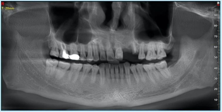 GBR dental tenting screws for bone grafting in anterior esthetic areas. - 图片3 2