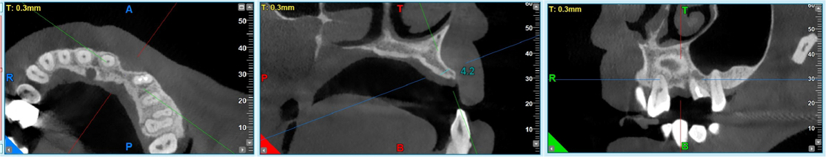 GBR dental tenting screws for bone grafting in anterior esthetic areas. - 图片4 1