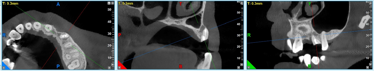 GBR dental tenting screws for bone grafting in anterior esthetic areas. - 图片5 1