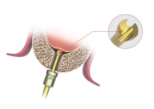 internal sinus lift