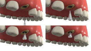 Dental Abutments