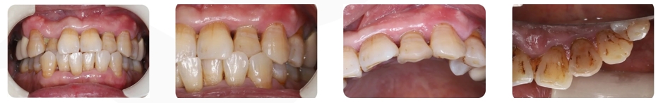 Immediate Implantation and GBR Techniques for Maxillary Anterior Teeth - 1 1