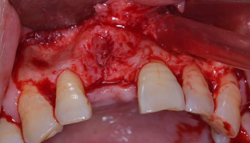 Titanium Mesh GBR Surgery in Maxillary Anterior Area - 1 1