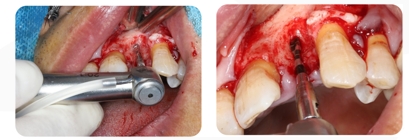 Immediate Implantation and GBR Techniques for Maxillary Anterior Teeth - 10