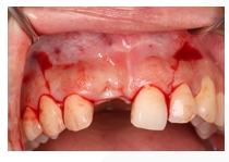 GBR Surgery in Maxillary Anterior Area - 11 2