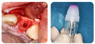 Immediate Implantation and GBR Techniques for Maxillary Anterior Teeth - 11 3