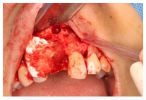 GBR Surgery in Maxillary Anterior Area - 112