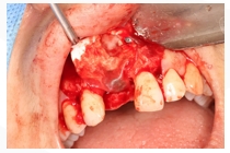 GBR Surgery in Maxillary Anterior Area - 113