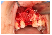 GBR Surgery in Maxillary Anterior Area - 114