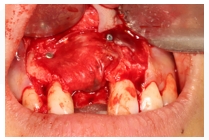 GBR Surgery in Maxillary Anterior Area - 115