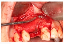 GBR Surgery in Maxillary Anterior Area - 116