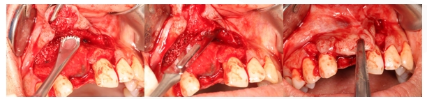 GBR Surgery in Maxillary Anterior Area - 117