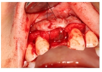 GBR Surgery in Maxillary Anterior Area - 118