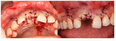 GBR Surgery in Maxillary Anterior Area - 119