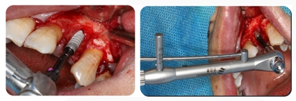 Immediate Implantation and GBR Techniques for Maxillary Anterior Teeth - 12 1