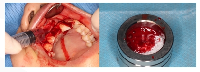 GBR Surgery in Maxillary Anterior Area - 12