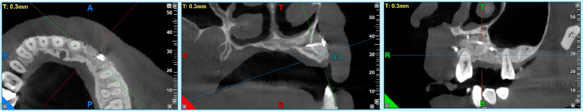 GBR dental tenting screws for bone grafting in anterior esthetic areas. - 12