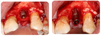 Immediate Implantation and GBR Techniques for Maxillary Anterior Teeth - 13 1