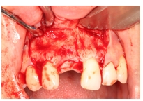 GBR Surgery in Maxillary Anterior Area - 13